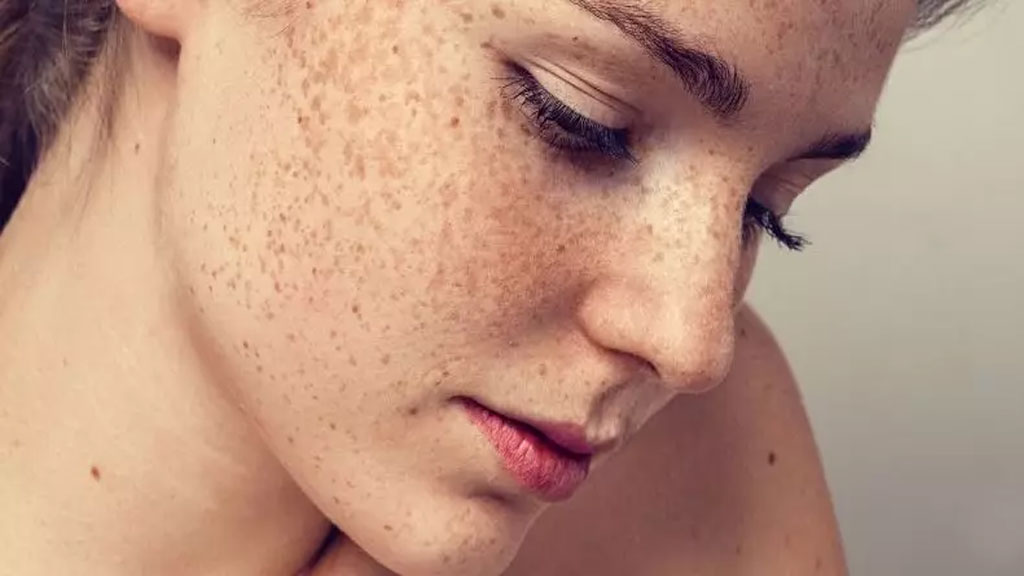 Freckles-Removal